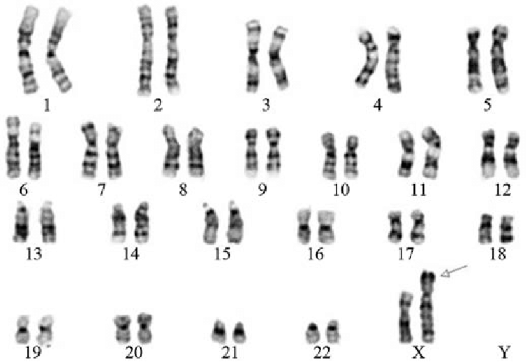 Chromosome Banding - G banding